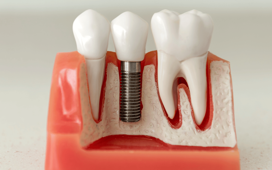 Custom dental implant options Edmond OK